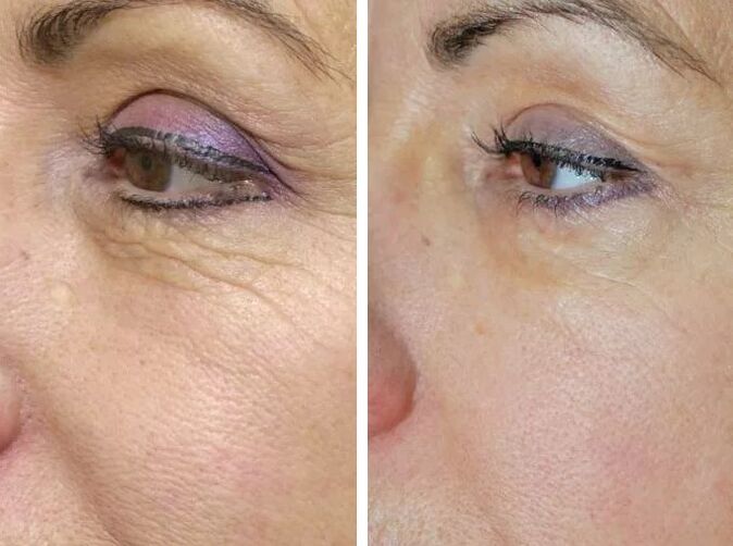 Field laser before and after