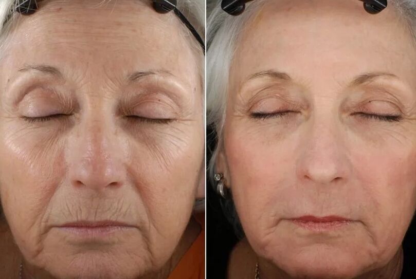 The results of fractional rejuvenation