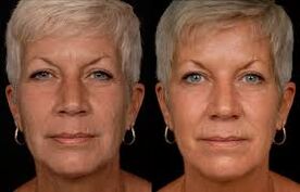 woman's face before and after